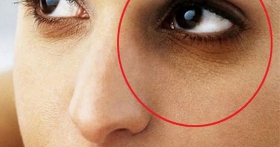 Dark circle/Fine lines