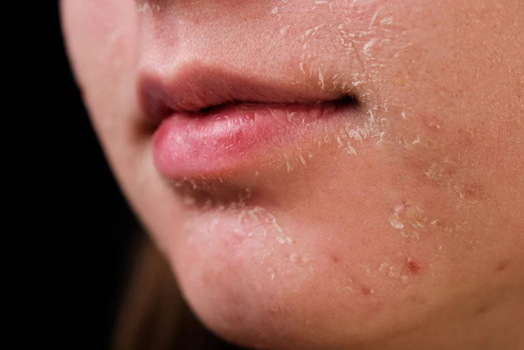 Dry skin